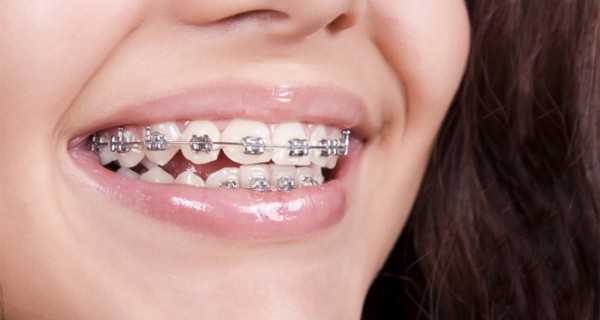 Plak Mı Diş Teli Mi? Diş Teli ve Şeffaf Plak Arasındaki Farklar Nelerdir?